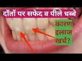 डेंटल फ्लोरोसिस (दांत पर सफ़ेद धब्बे)Dental fluorosis,symptoms & its solutions-Dr.praveen Bhatia