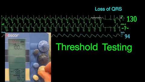 Temporary pacemakers 101: Output/stimulation
