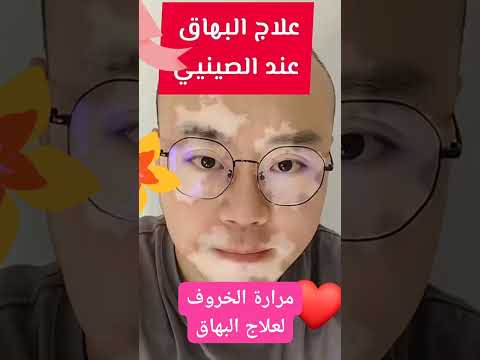 مرارة الخروف لعلاج البهاق