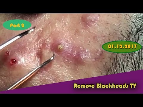 Acne And Blackhead, popping blackheads,cysts blackheads removal on face (Part)