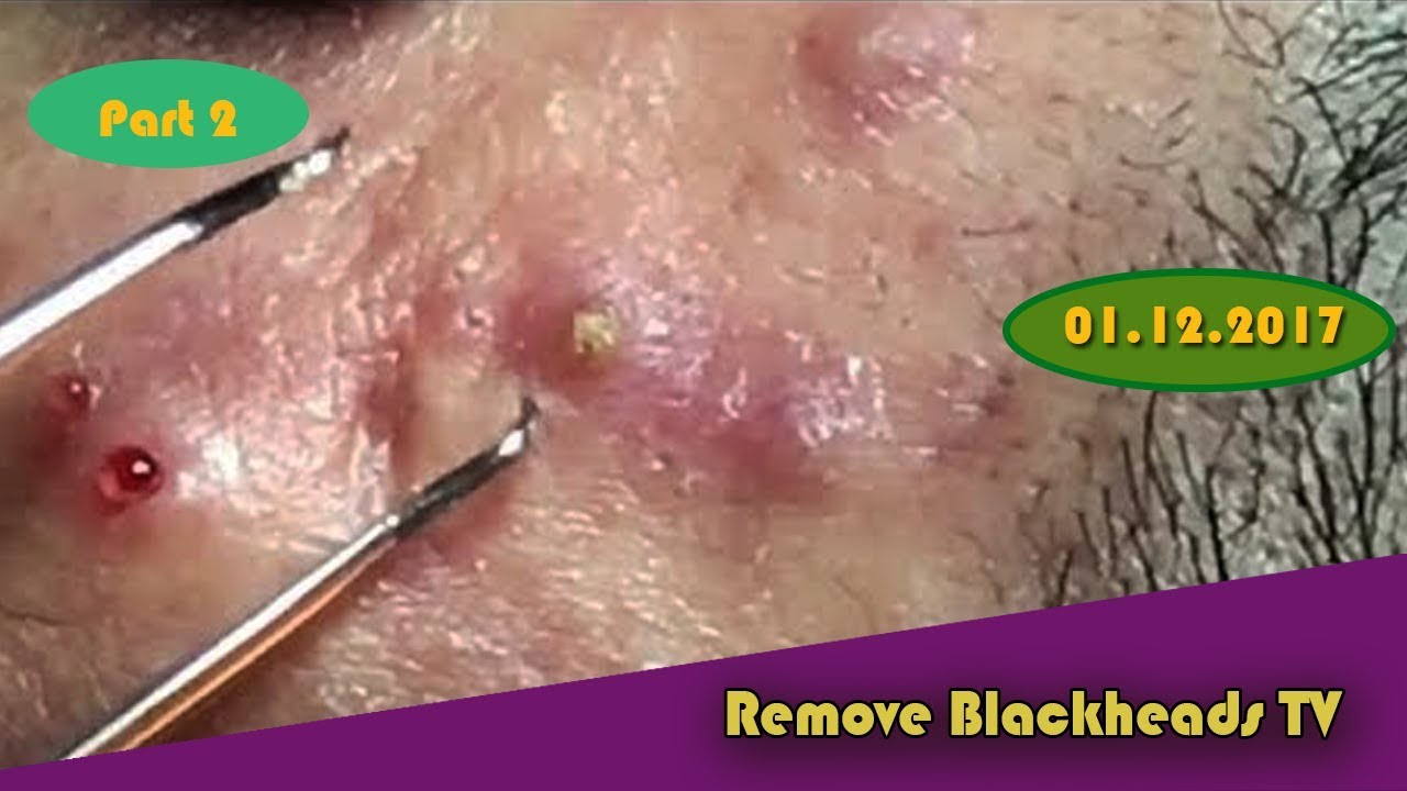 Acne And Blackhead, popping blackheads,cysts blackheads removal on face