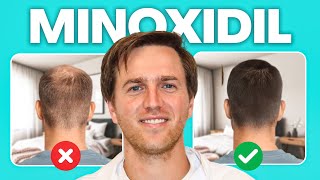 10 choses que personne ne vous dit sur le minoxidil (mais que vous devriez savoir)