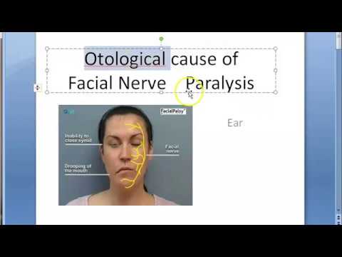 ENT Otological Cause of Facial Nerve Paralysis Ear Infection