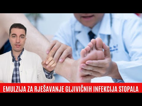 Video: Tehnika Recesije Zidova Bleb Za Popravak Divovske Krvavice Nakon Implantacije Ventila Ahmeda Glaukoma: Prikaz Slučaja