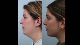 How to Choose Between a Deep Neck Lift vs Neck Liposuction: Non-Graphic Demonstration #youthful