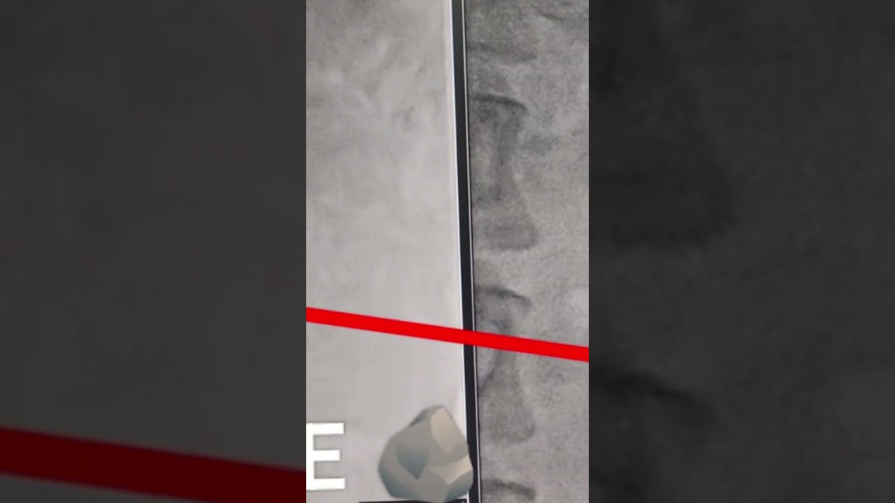 RIRS Surgery at Urology Dept of United Superspeciality Hospital, Gondia