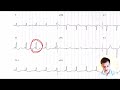 ЭКГ за 100 минут №8: Синдромы на ЭКГ
