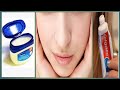 กำจัดสิวเสี้ยน Colgate Toothpaste for Face Whitening | Vaseline and Colgate | Blackhead Removal