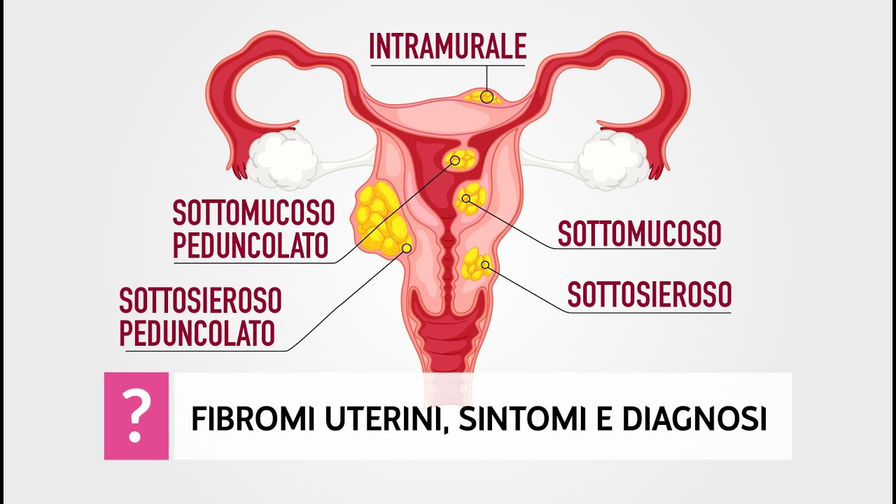 Fibromi uterini, cause, sintomi e diagnosi