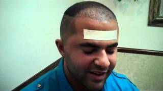 Dr. Jeffrey Epstein: FUE Hair Transplant Procedure 1 day Post op - Male Patient