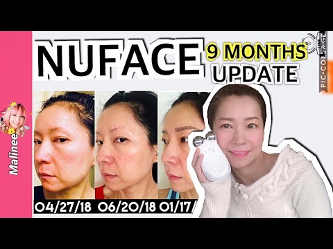 nuface-trinity-9-months-results-before-and-after-pictures-update-review