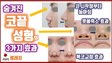 잘된사람만 아는 코성형의 3가지 숨겨진 효과 (by 성형외과 전문의)