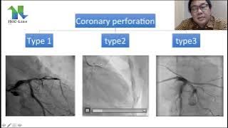 Complication During PCI