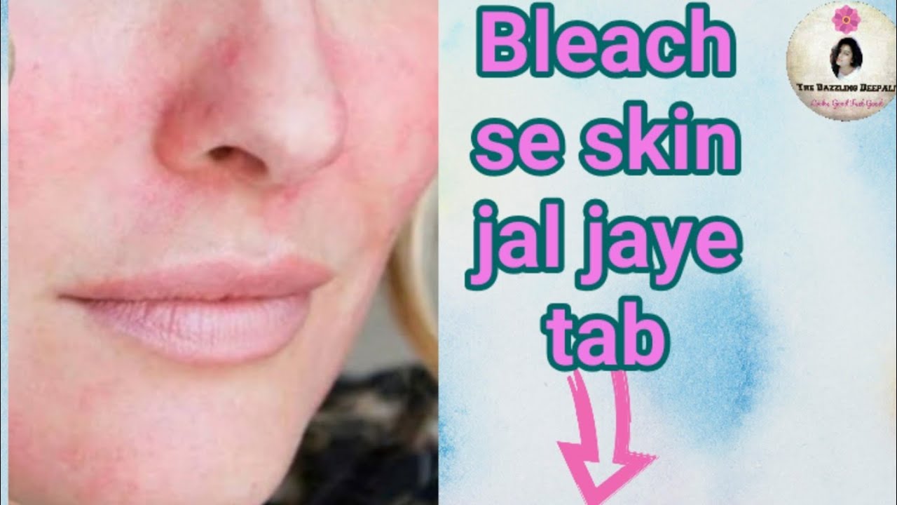 BLEACH SE SKIN JAL JAYE TAB KYA KARE BLEACH KARNE KE TURANT BAD bleach-se-skin-jal-jaye-tab-kya-kare-bleach-karne-ke-turant-bad