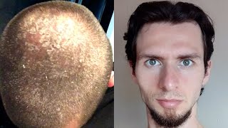 8 years no shampoo results