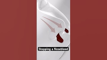 The right way to stop a nosebleed (3D Animation)