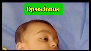 A Patient With Opsoclonus