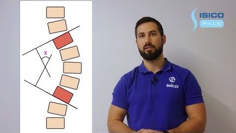 Isico Pills - "How to assess Cobb angle" presentend by Luca Selmi, PT