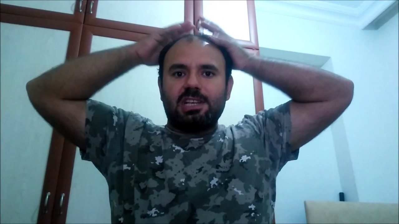 protez saç yorumları