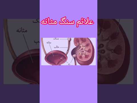 علائم سنگ مثانه  مثانه ادرار طب روز