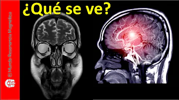 ¿Se ve la infección cerebral en la resonancia magnética?