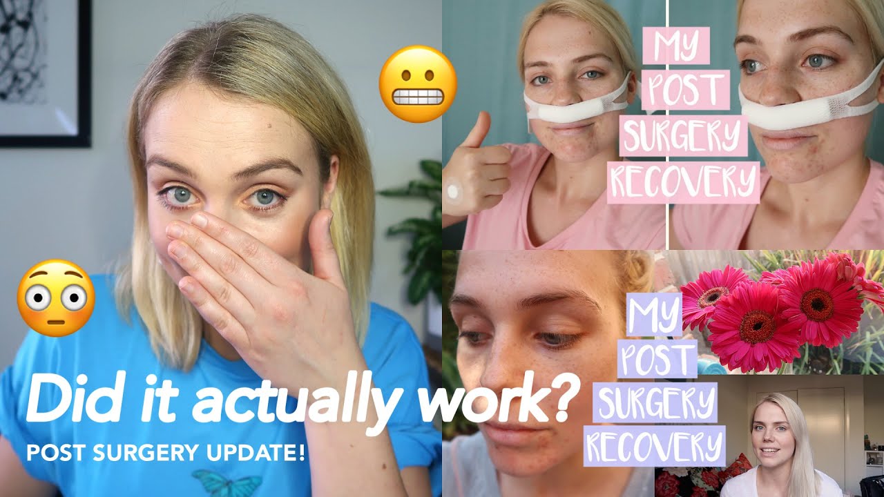 what-to-expect-after-nasal-surgery-2021-three-years-post-sinus