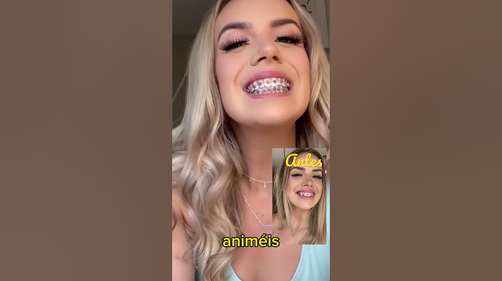 Amazing before and after braces!