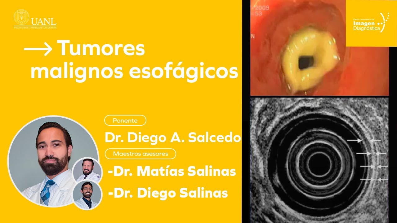 Tumores malignos esofágicos por el Dr. Diego Azamat.