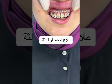 علاج انحسار اللثه    