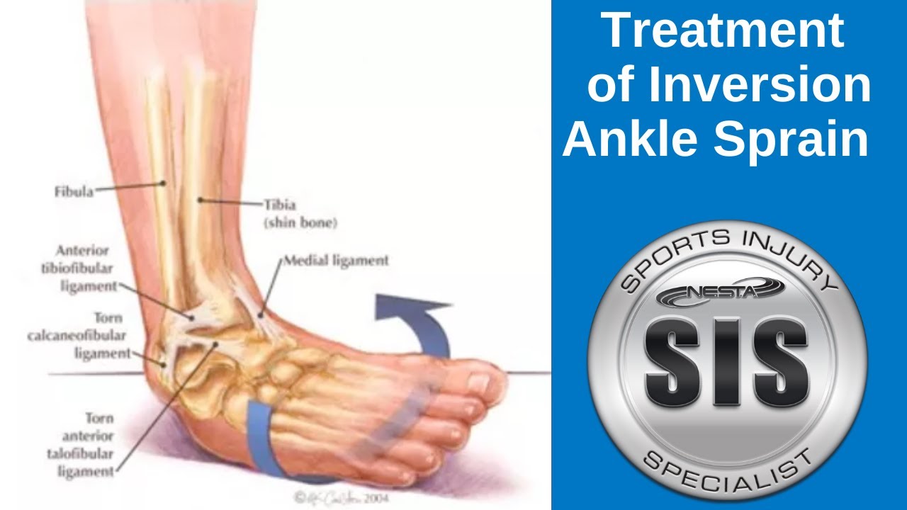 Inversion Ankle Sprain Treatment 