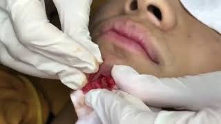 Big Pimples Acne Treament Under The Skin