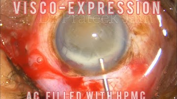 #18 Highlights:MSICS: Viscoexpression of large nucleus + Posterior capsular Polish #DrPrateekJain