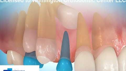 Maxillary Deciduous Canine Extraction (Mixed Dentition)