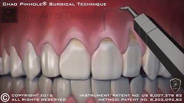 Dr Weiss Offers the Pinhole Surgical Technique™