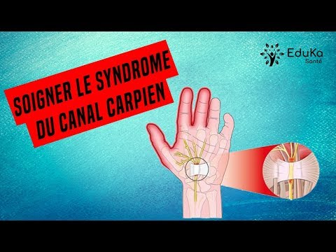 Vidéo: Traitement Du Syndrome Du Canal Carpien Avec Des Remèdes Et Des Méthodes Populaires