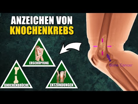 Video: Wie wird auf Knochenkrebs untersucht?