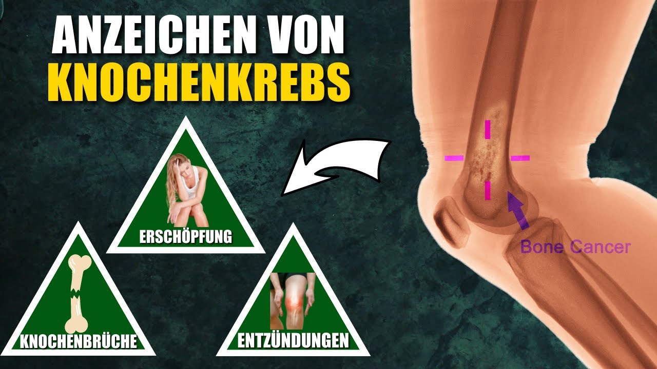 9 Anzeichen von Knochenkrebs, die du niemals ignorieren solltest