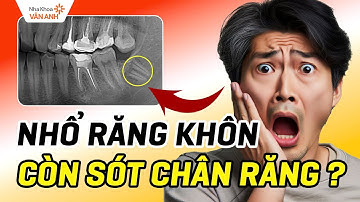 Nhổ Răng Khôn Nhưng Còn Sót Chân Răng – Cảnh Báo 4 Dấu Hiệu Không Thể Chủ Quan