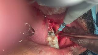 Upper and lower left wisdom tooth removal video | Third molar oral surgical procedure at Richardsons