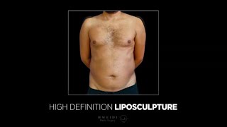 Before and After HD Liposculpture - قبل و بعد نحت الجسم عالى التحديد