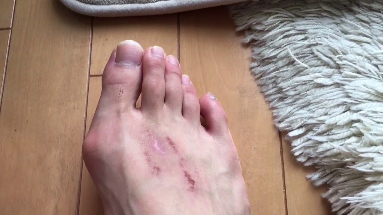 Finger Dystonia 足の指が勝手に動く Youtube