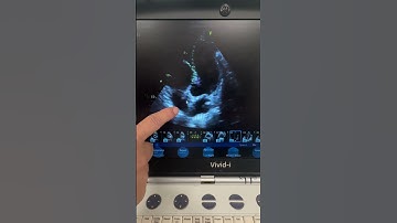 Heart Valve Echocardiogram: Adam Pick (2023)