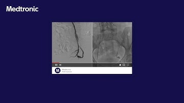 Left ovarian vein embolization