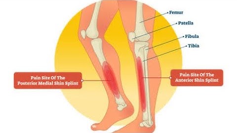 Shin Pain (Part-2) | Shin Splint| Medial Tibial Stress Syndrome | #Sportsmedicinelecture