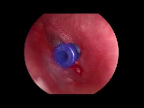Video: Zdravljenje vnetja srednjega ušesa doma