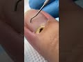 Satisfying nail cleaning process#nailcare #pedicure #satisfying #nailtech #oddlysatisfying #fyp