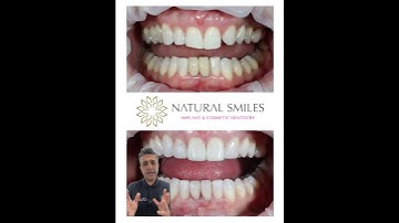 Composite Bonding   masking teeth shape