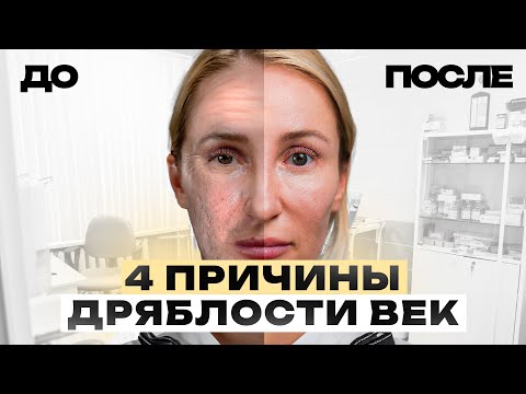 Как избавиться от ДРЯБЛОСТИ век? Топ причин ПТОЗА век