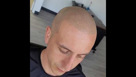 Scalp Micropigmentation  Healed  1st Session, After 2nd
