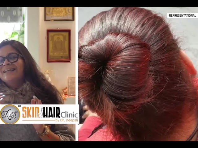 Understanding Premature Greying: Causes, Management, and Prevention